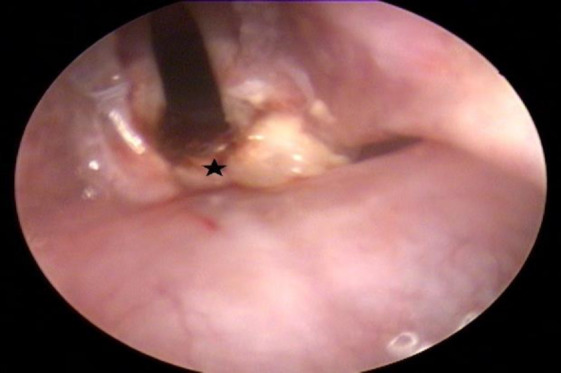 Can Epirubicin Be Used in Laryngology Practice Like Mitomycin? An Experimental and Pioneering Study.