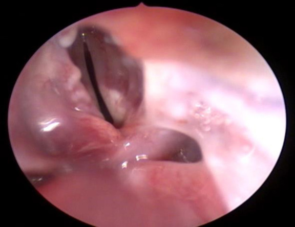 Can Epirubicin Be Used in Laryngology Practice Like Mitomycin? An Experimental and Pioneering Study.