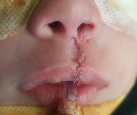 Cleft Lip Techniques and Surgical Outcome in Patients Referred To Abuzar Children's Hospital in Ahvaz, Southern Iran.