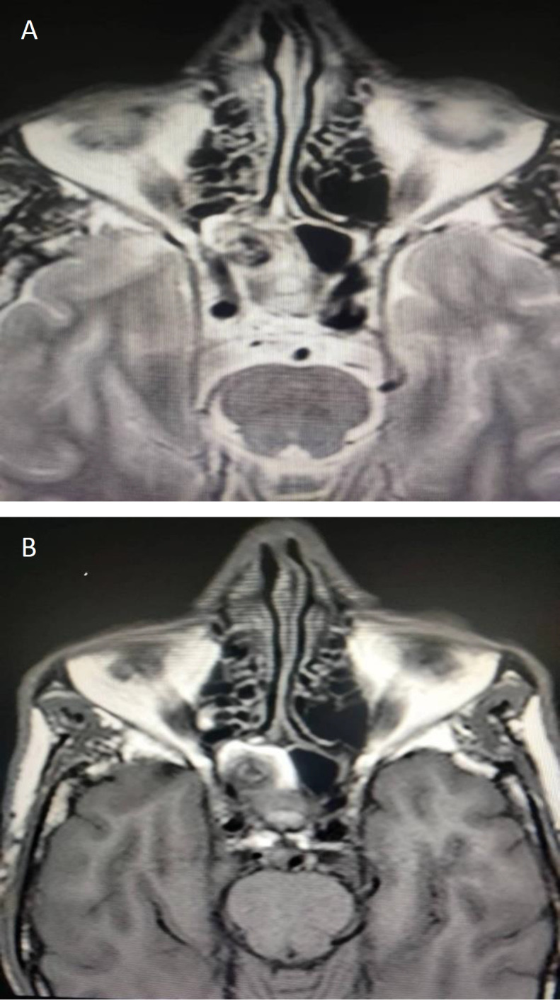 Intrasphenoidal Internal Carotid Artery Aneurysm: Rare Cause of Recurrent Epistaxis.