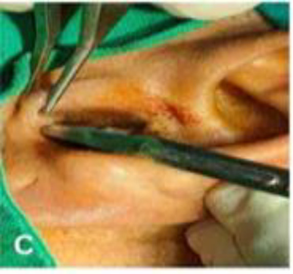 Endoscopic Transcanal Type 1 Tympanoplasty with Cartilage Perichondrium Graft; A Prospective Study.