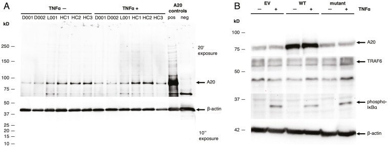 A novel missense variant in TNFAIP3 associated with autoimmunity reveals the contribution of STAT1/mTOR pathways.