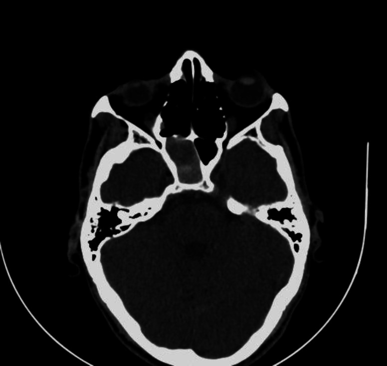 Intrasphenoidal Internal Carotid Artery Aneurysm: Rare Cause of Recurrent Epistaxis.