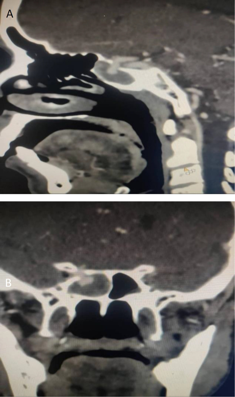Intrasphenoidal Internal Carotid Artery Aneurysm: Rare Cause of Recurrent Epistaxis.