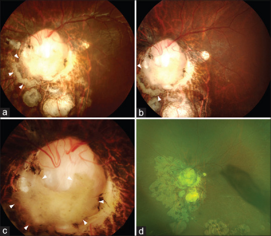 Retinal detachments associated with choroidal colobomas.