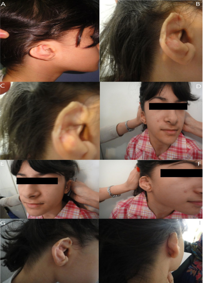 Ipsilateral Intact Concha as a Rotational Flap for Reconstruction of Congenital Auricular Defect.