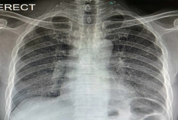 Ipsilateral Oropharyngeal and Cervical Lymph Node Tuberculosis Simulating Oropharyngeal Malignancy with Regional Lymph Node Metastasis: A Case Report.