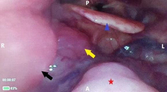 Ipsilateral Oropharyngeal and Cervical Lymph Node Tuberculosis Simulating Oropharyngeal Malignancy with Regional Lymph Node Metastasis: A Case Report.