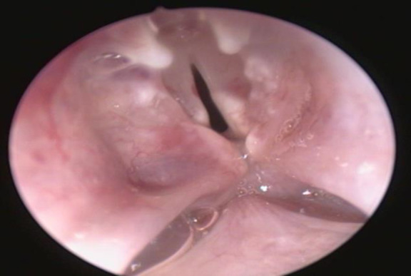 Can Epirubicin Be Used in Laryngology Practice Like Mitomycin? An Experimental and Pioneering Study.