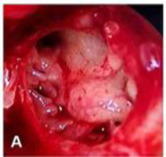 Endoscopic Transcanal Type 1 Tympanoplasty with Cartilage Perichondrium Graft; A Prospective Study.