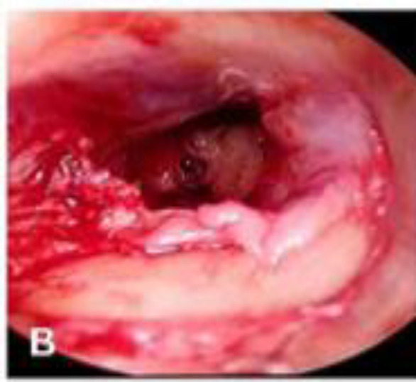 Endoscopic Transcanal Type 1 Tympanoplasty with Cartilage Perichondrium Graft; A Prospective Study.