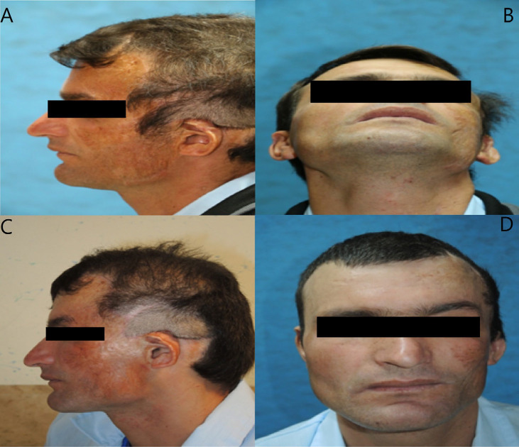 Ipsilateral Intact Concha as a Rotational Flap for Reconstruction of Congenital Auricular Defect.