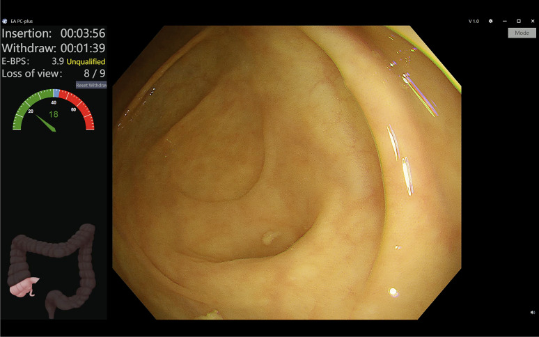 Artificial Intelligence in Colonoscopy: Where Are We Now in 2024?