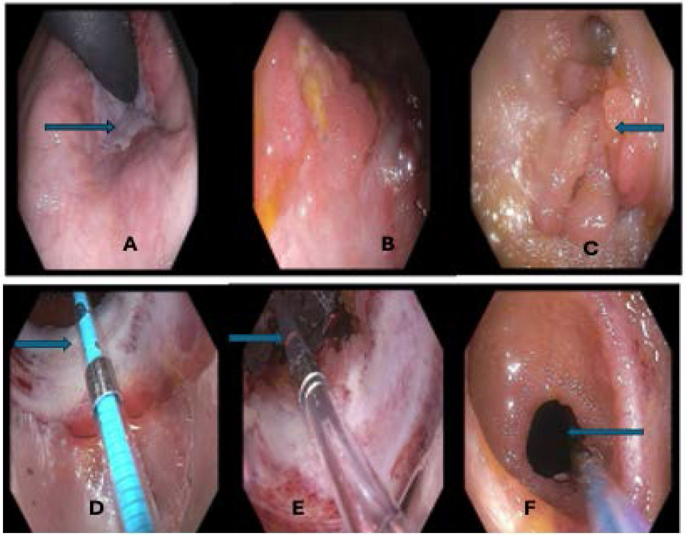 The Efficiency of Multimodal Opioid-Free Anesthetic Management in a Patient Undergoing Major Abdominal Surgery - Case Report.