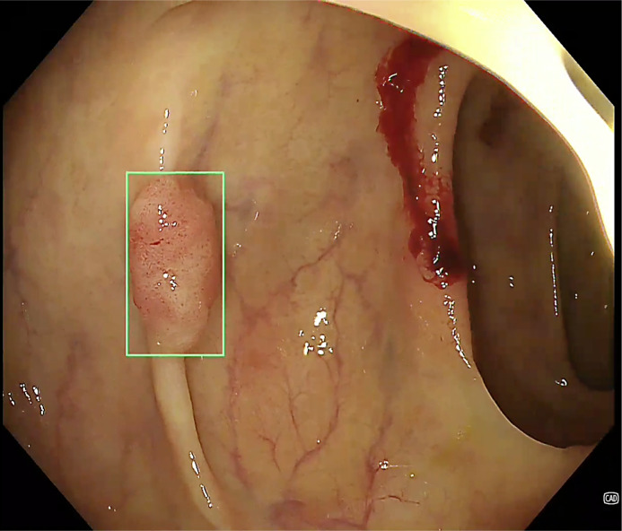 Artificial Intelligence in Colonoscopy: Where Are We Now in 2024?