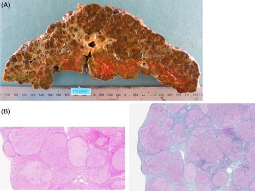 Liver transplantation in glycogen storage disease type III: A case-series