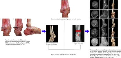 Classification and pathoanatomy of posterior malleolus fracture based on posterior malleolus-associated ligaments and ankle stability