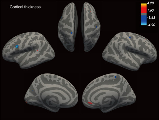 Persistent alterations in gray matter in COVID-19 patients experiencing sleep disturbances: a 3-month longitudinal study.