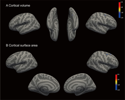 Persistent alterations in gray matter in COVID-19 patients experiencing sleep disturbances: a 3-month longitudinal study.