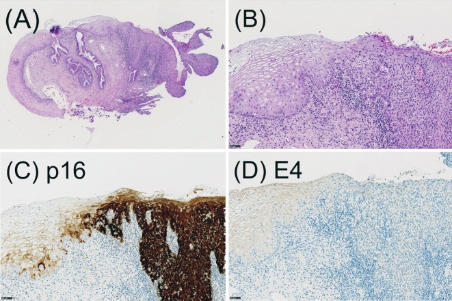 p16<sup>INK4a</sup> and HPV E4 immunohistochemistry for the prediction of regression of cervical intraepithelial neoplasia grade 2-A historical cohort study.