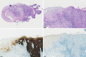 p16<sup>INK4a</sup> and HPV E4 immunohistochemistry for the prediction of regression of cervical intraepithelial neoplasia grade 2-A historical cohort study.