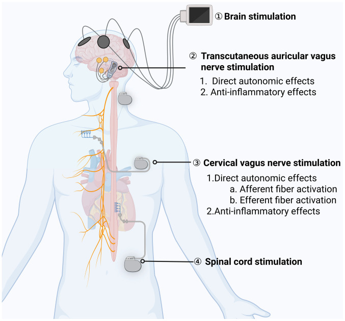 Brain‑heart axis: Neurostimulation techniques in ischemic heart disease (Review).