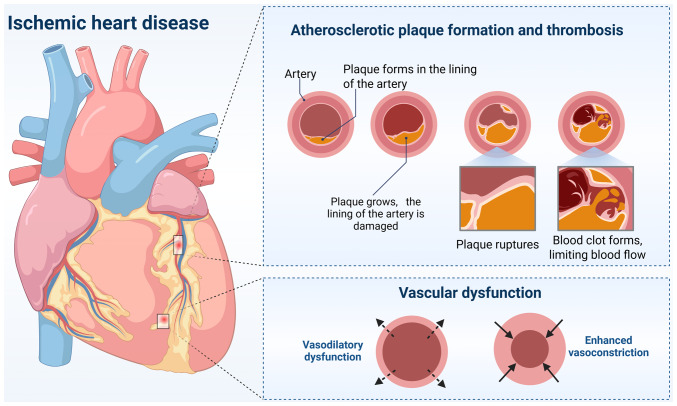 Brain‑heart axis: Neurostimulation techniques in ischemic heart disease (Review).