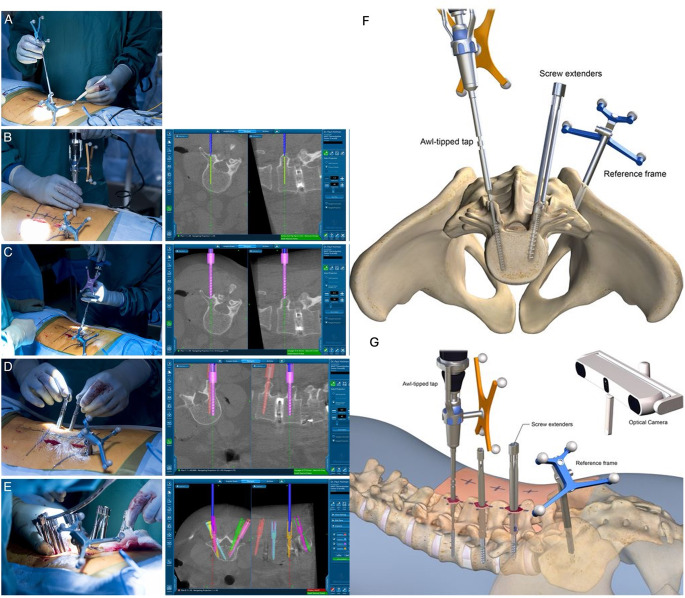 Artificial Intelligence in Spine Surgery: Imaging-Based Applications for Diagnosis and Surgical Techniques.
