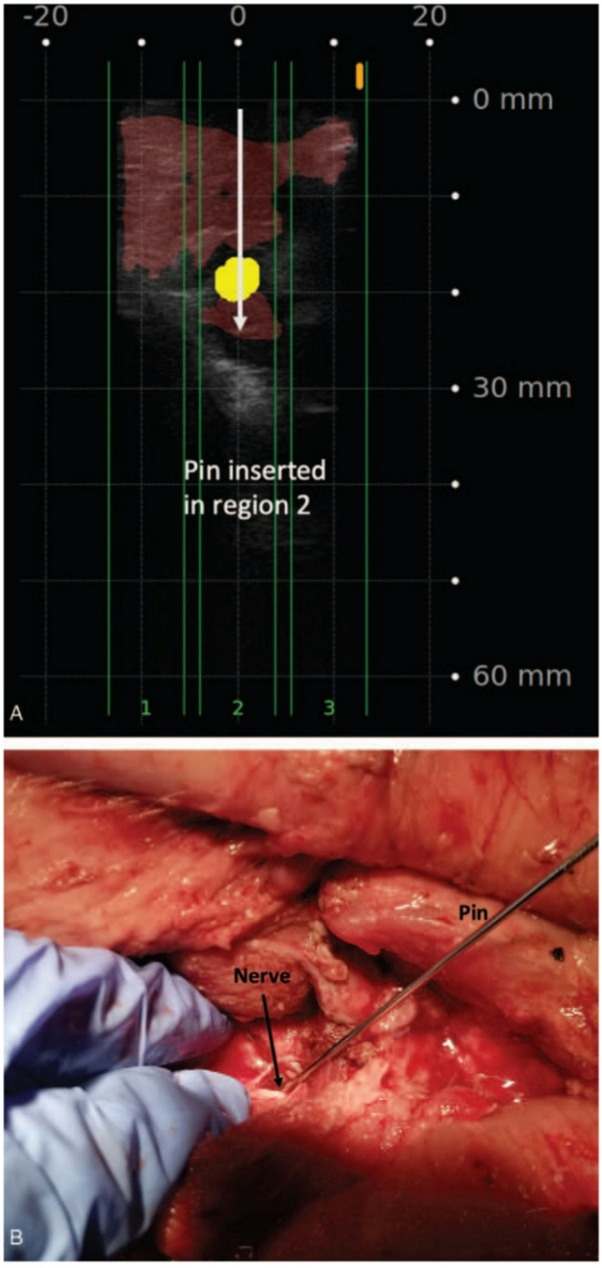 Artificial Intelligence in Spine Surgery: Imaging-Based Applications for Diagnosis and Surgical Techniques.