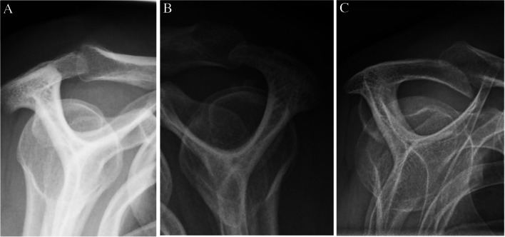 Radiographic findings in patients suspected of subacromial impingement syndrome in relation to shoulder pain and disability.