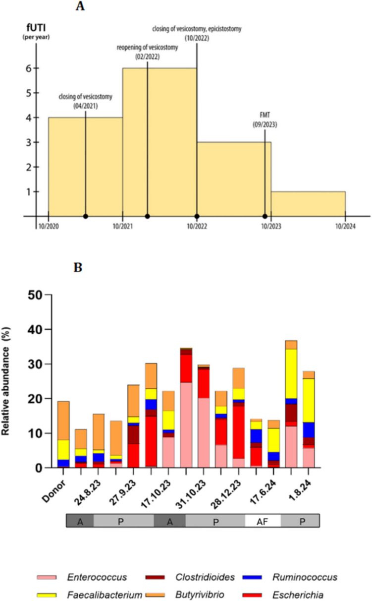 The effect of fecal microbial transplantation in a pediatric patient after 28 episodes of febrile urinary tract infection.