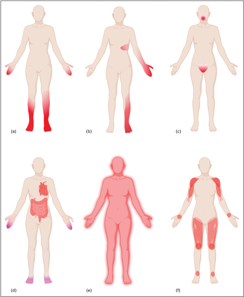 Small fiber neuropathy: expanding diagnosis with unsettled etiology.