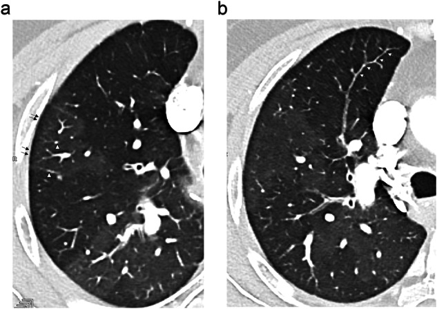 Lung microvasculopathy in chronic thromboembolic pulmonary hypertension: high-resolution findings with photon-counting detector CT in 29 patients.