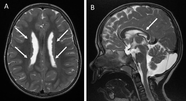 Expanded CRB2-related disease phenotype: multisystem involvement and post-transplant complications in monozygotic twins.