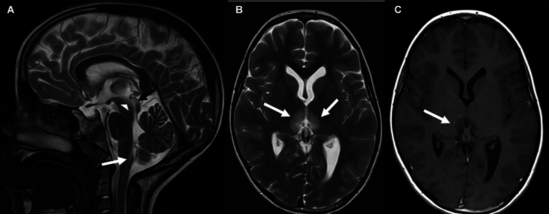 Nausea, Vertical Gaze Palsy, and Excessive Sleep: An Unusual Presentation of Pediatric AQP4-Antibody Positive Neuromyelitis Optica Spectrum Disorder.