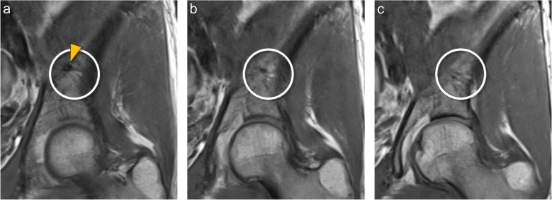 Prevalence and origin of prominent nutrient channels of the ilium bone on MR-imaging.