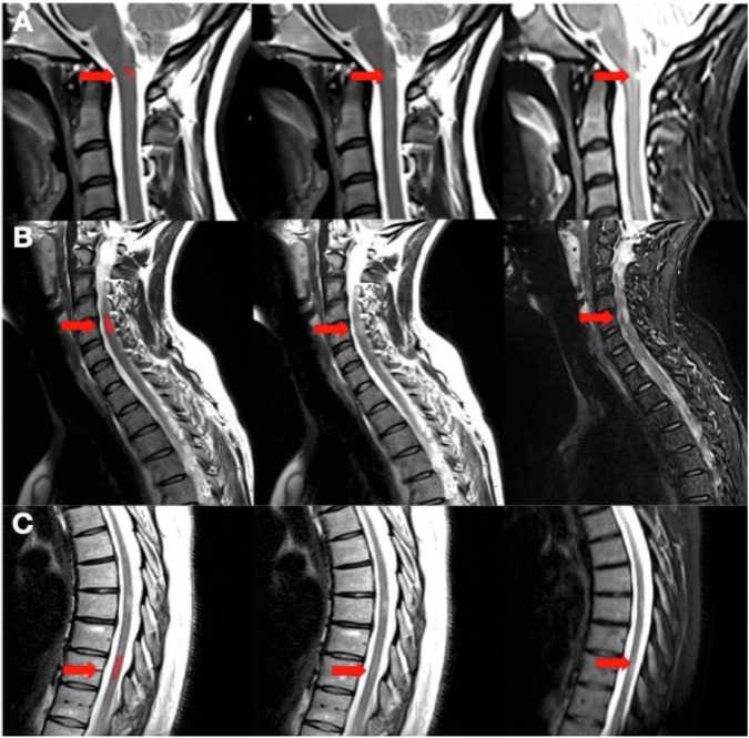 Evaluation of a deep learning segmentation tool to help detect spinal cord lesions from combined T2 and STIR acquisitions in people with multiple sclerosis.