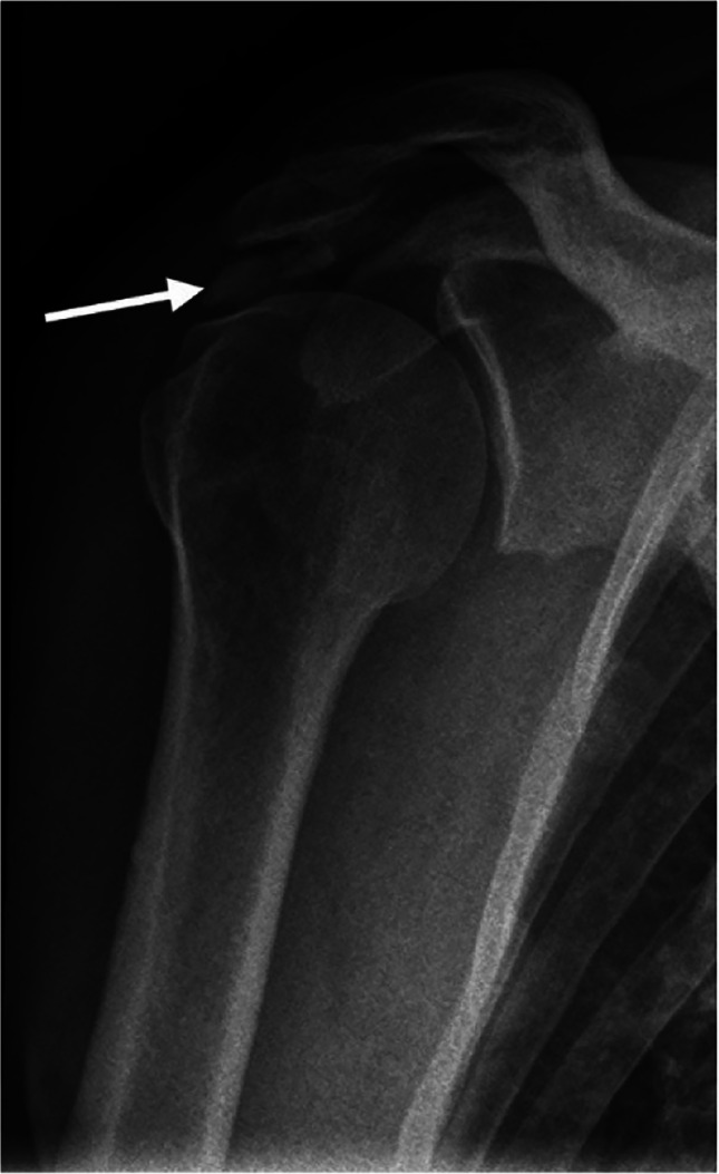 Radiographic findings in patients suspected of subacromial impingement syndrome in relation to shoulder pain and disability.