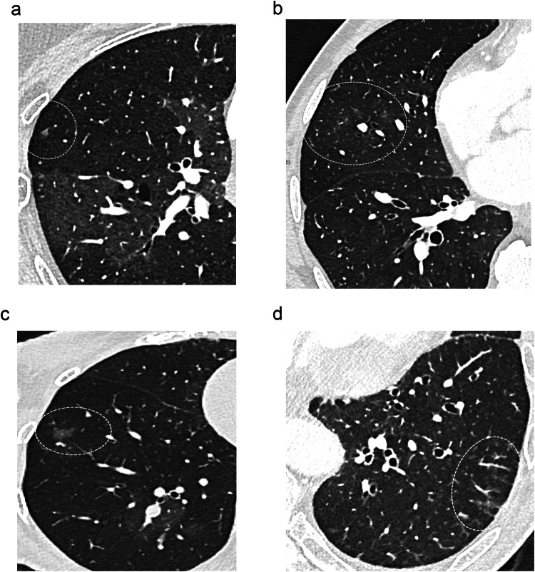 Lung microvasculopathy in chronic thromboembolic pulmonary hypertension: high-resolution findings with photon-counting detector CT in 29 patients.