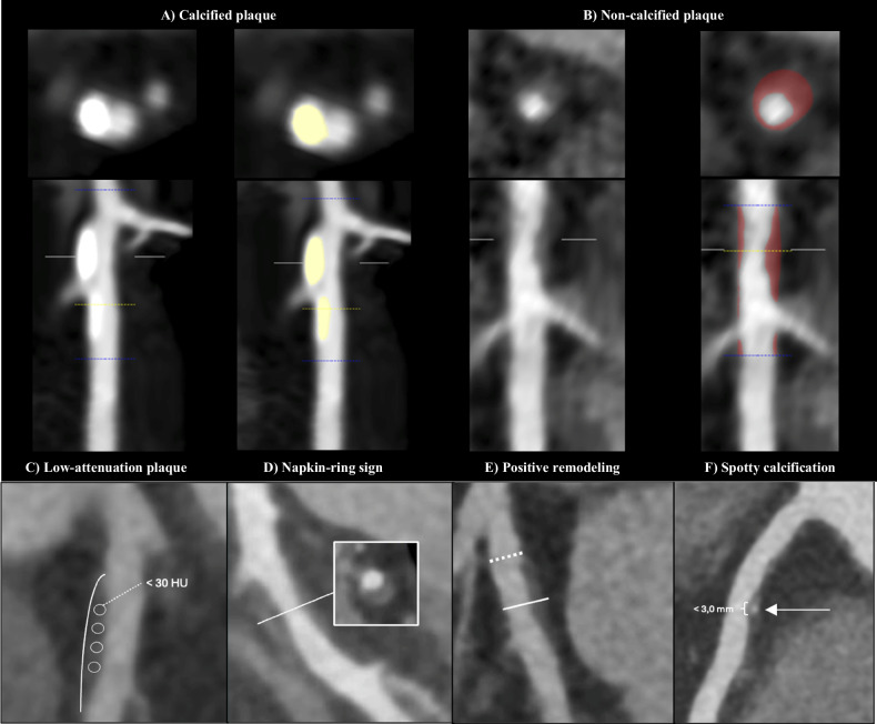 Influence of plaque characteristics by coronary computed tomography angiography on lesion-specific ischemia: a systematic review and meta-analysis.