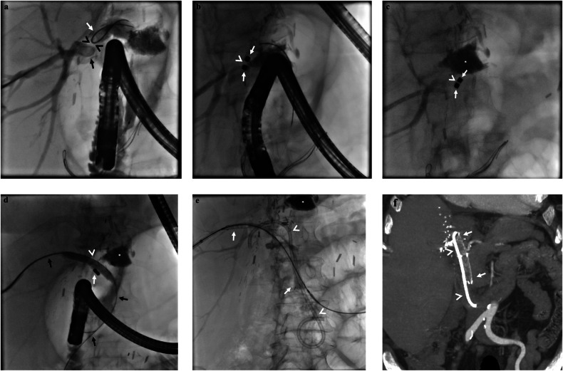 Combined endoscopic-percutaneous approach for magnetic compression anastomosis in post-transplant anastomotic biliary strictures.