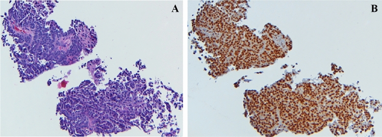 Carboplatin, gemcitabine, and mifepristone for advanced breast and recurrent/persistent epithelial ovarian cancer.