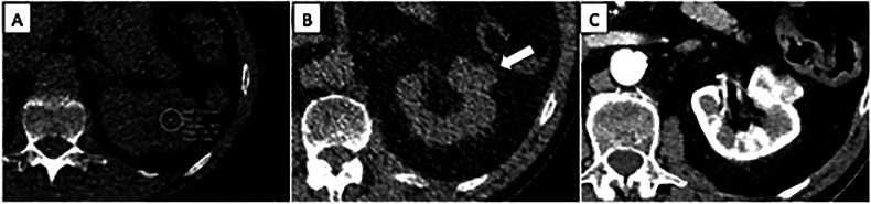 Pros and cons of reporting incidental findings in lung cancer screening.