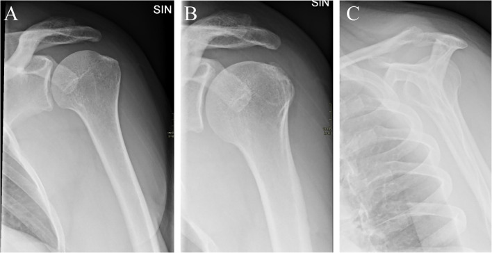 Radiographic findings in patients suspected of subacromial impingement syndrome in relation to shoulder pain and disability.