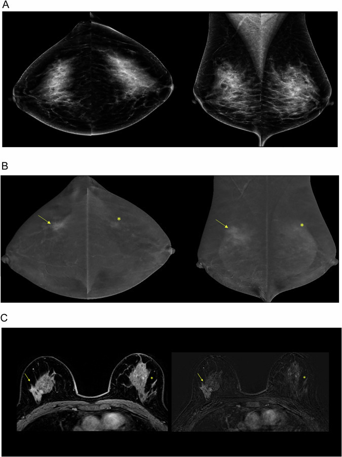 Improving the diagnostic performance of contrast-enhanced mammography through lesion conspicuity and enhancement quantification.