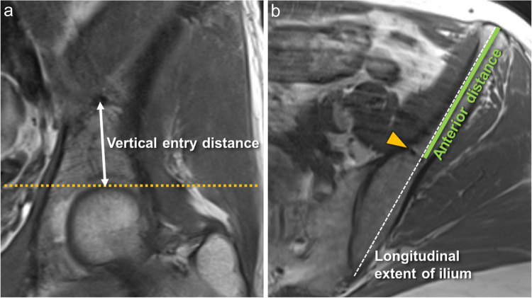 Prevalence and origin of prominent nutrient channels of the ilium bone on MR-imaging.