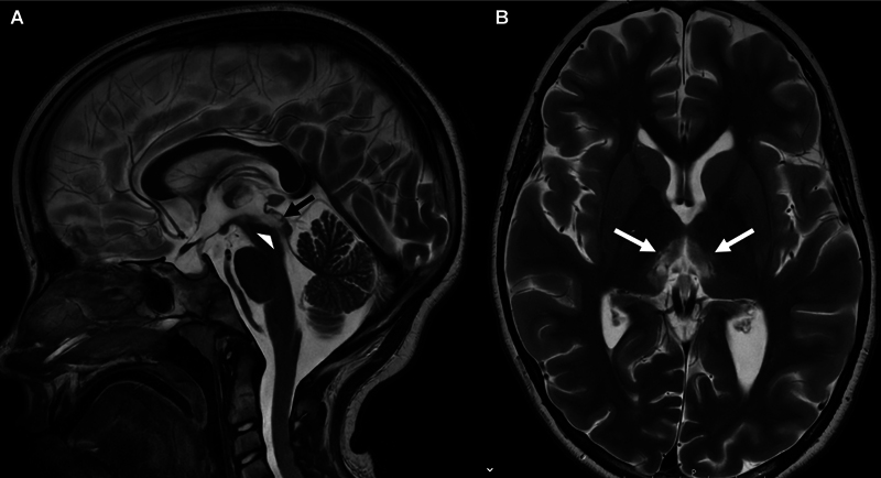 Nausea, Vertical Gaze Palsy, and Excessive Sleep: An Unusual Presentation of Pediatric AQP4-Antibody Positive Neuromyelitis Optica Spectrum Disorder.