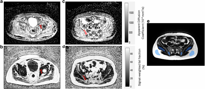 Influence of imaging method on fat fraction estimation for assessing bone marrow in metastatic prostate cancer.