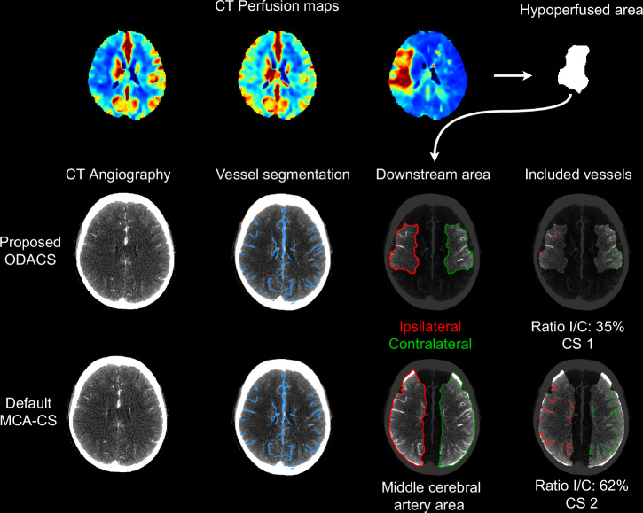 Automated collateral assessment restricted to the hypoperfused area for distal vessel occlusions in ischemic stroke.
