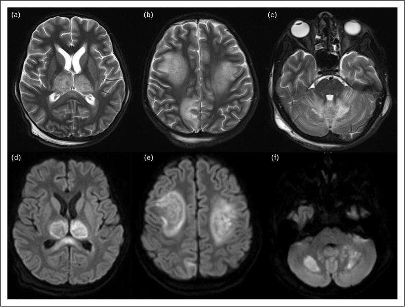 Dengue encephalitis: what's new?